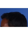 After Hair Transplant&nbsp;Front